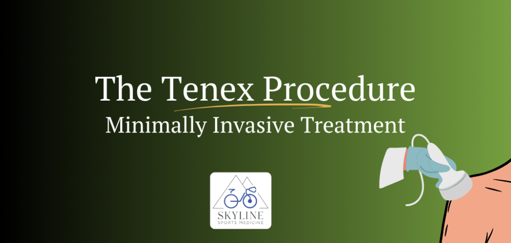 Skyline Sports Medicine Tenex Procedure